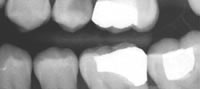 Dental-Fillings_1