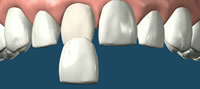 DentalVeneers
