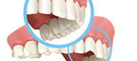 bonding-dentist