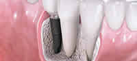 dental-implants_1