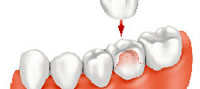 dental_crown